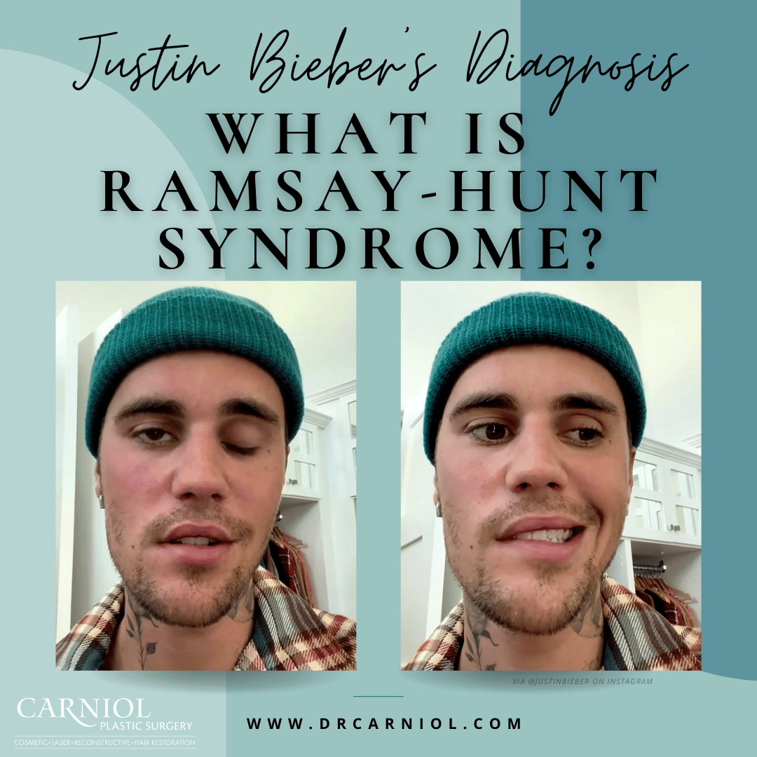 What is Ramsay Hunt Syndrome and how has it affected Justin Bieber? - AS USA