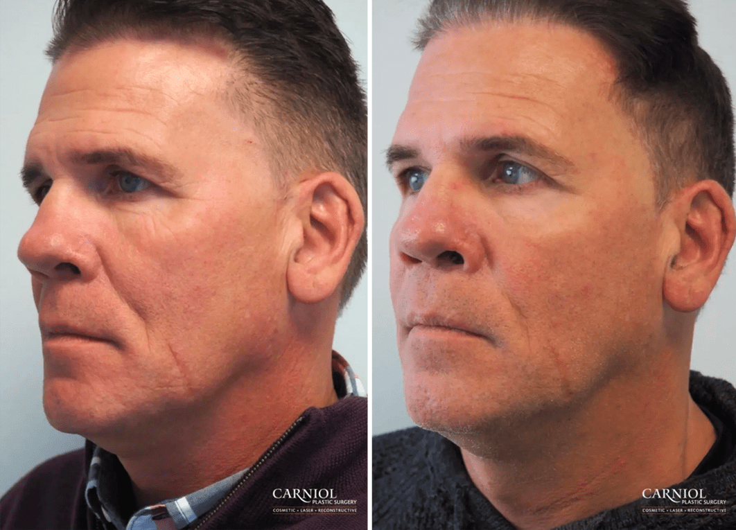 before after non surgical facelifts summit nj 1
