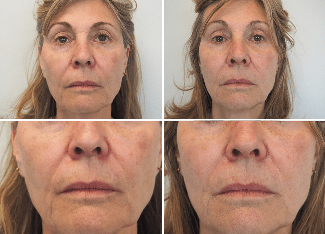 before after non surgical facelifts summit nj 2