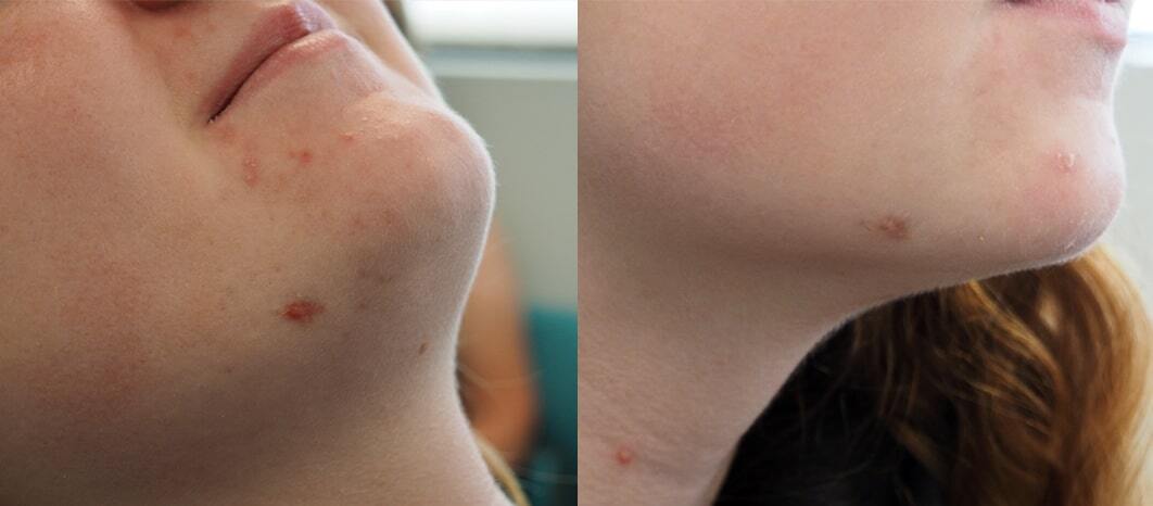 before after acne scar treament summit nj