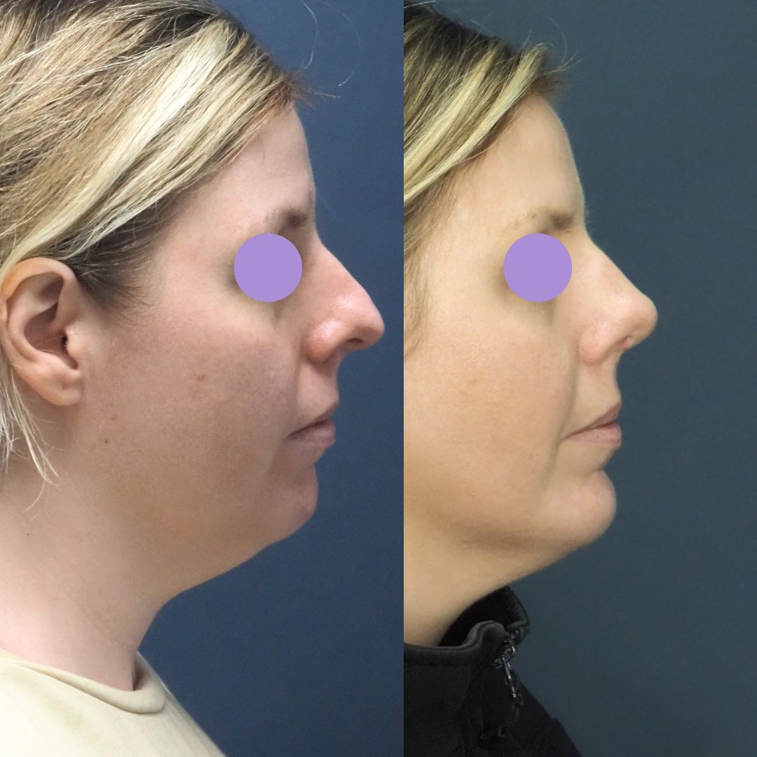 Rhino, Chin Lipo (3)